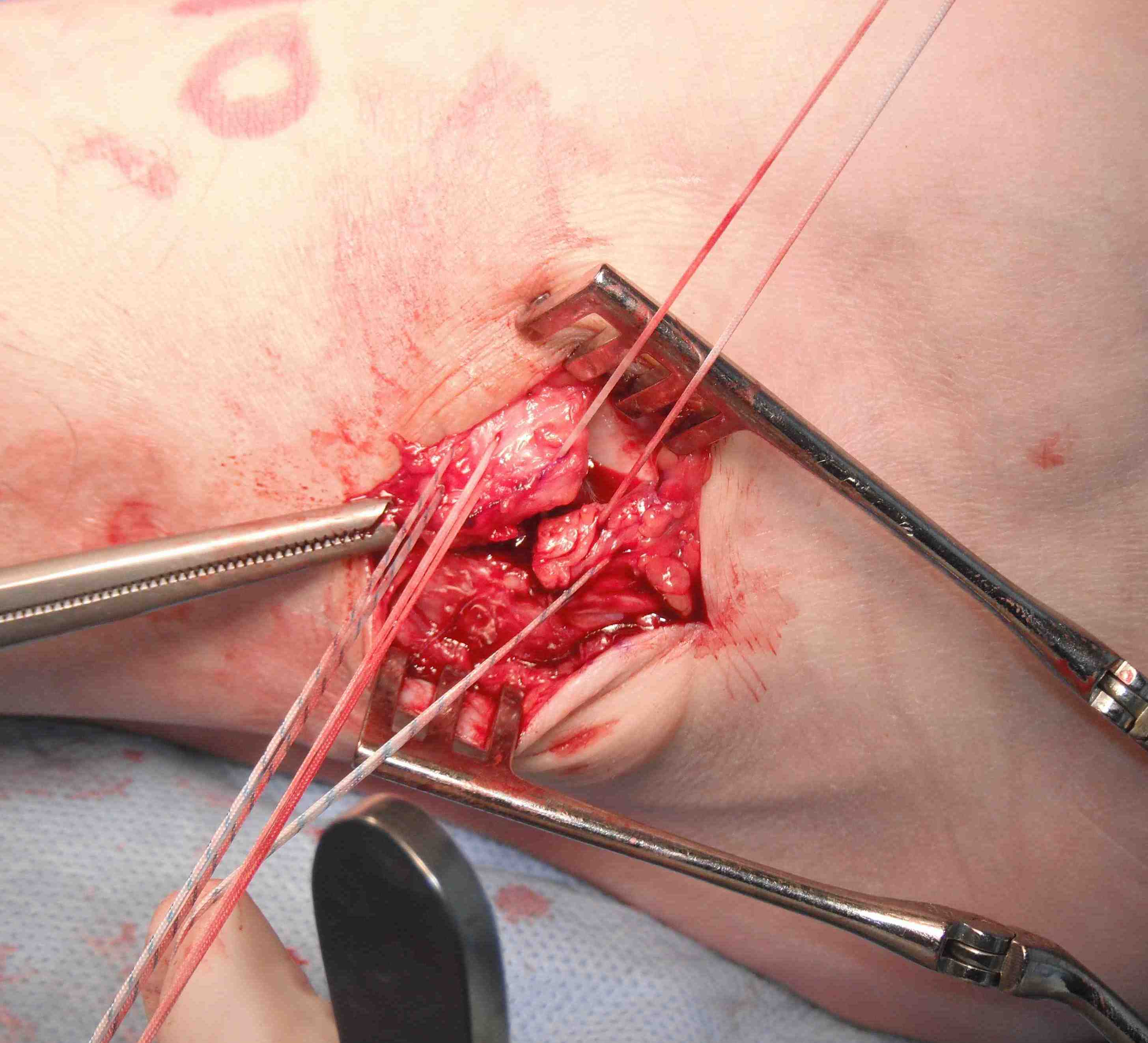 2 Sutures to Close Interval